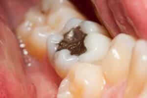 metal in the mouth its recyclable 632b2001b9488