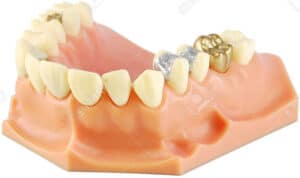what to do when dental crowns go bad 632b1feebe719