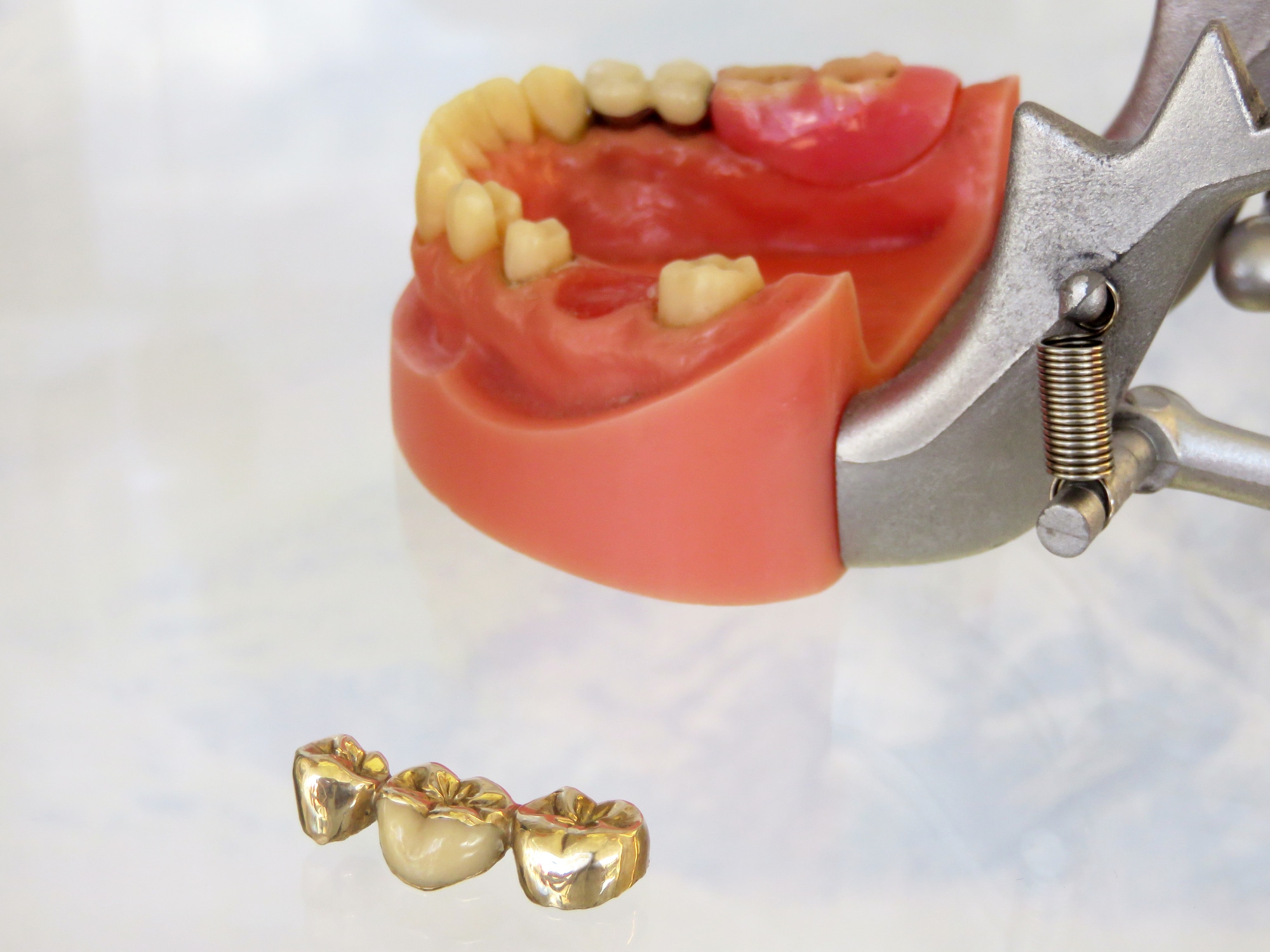 Why Choose a Specialized Dental Scrap Buyer? Crown Buyers